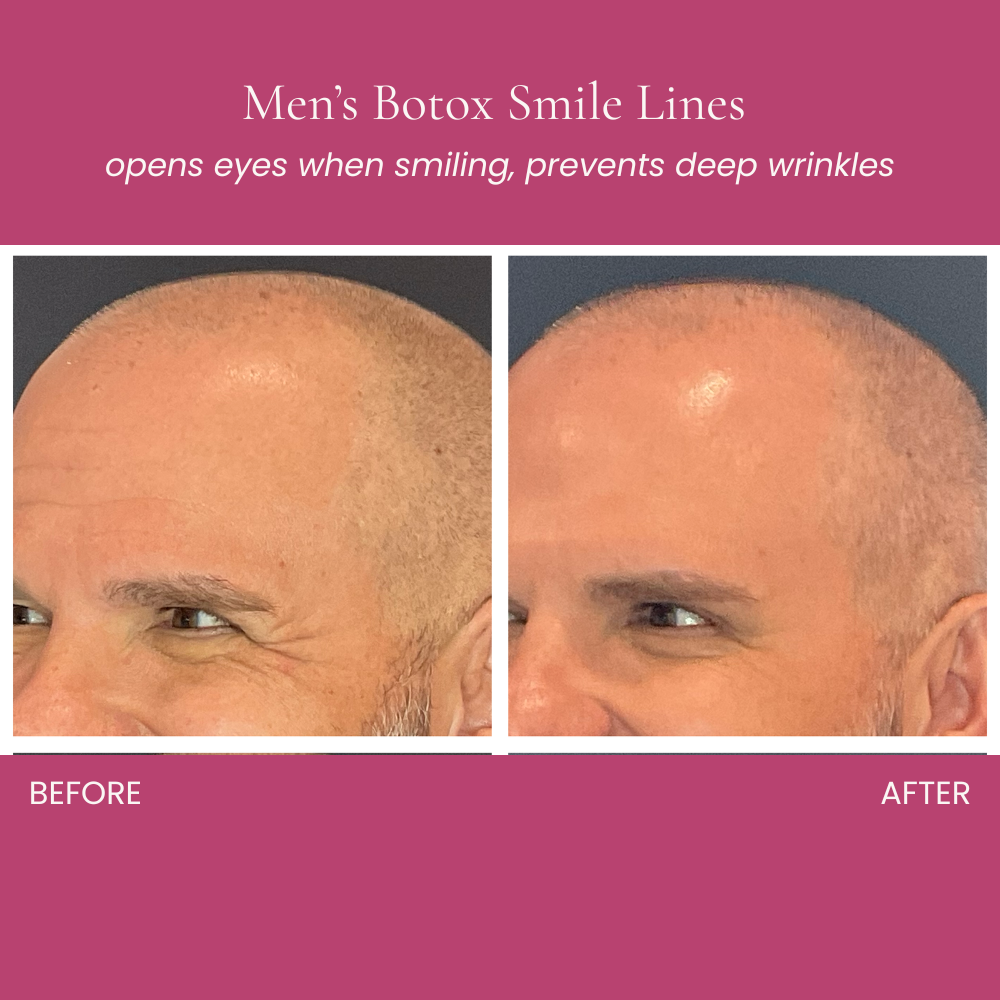 Botox for Men Before and After