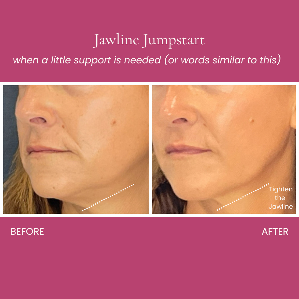 Jawline Jumpstart Before and After