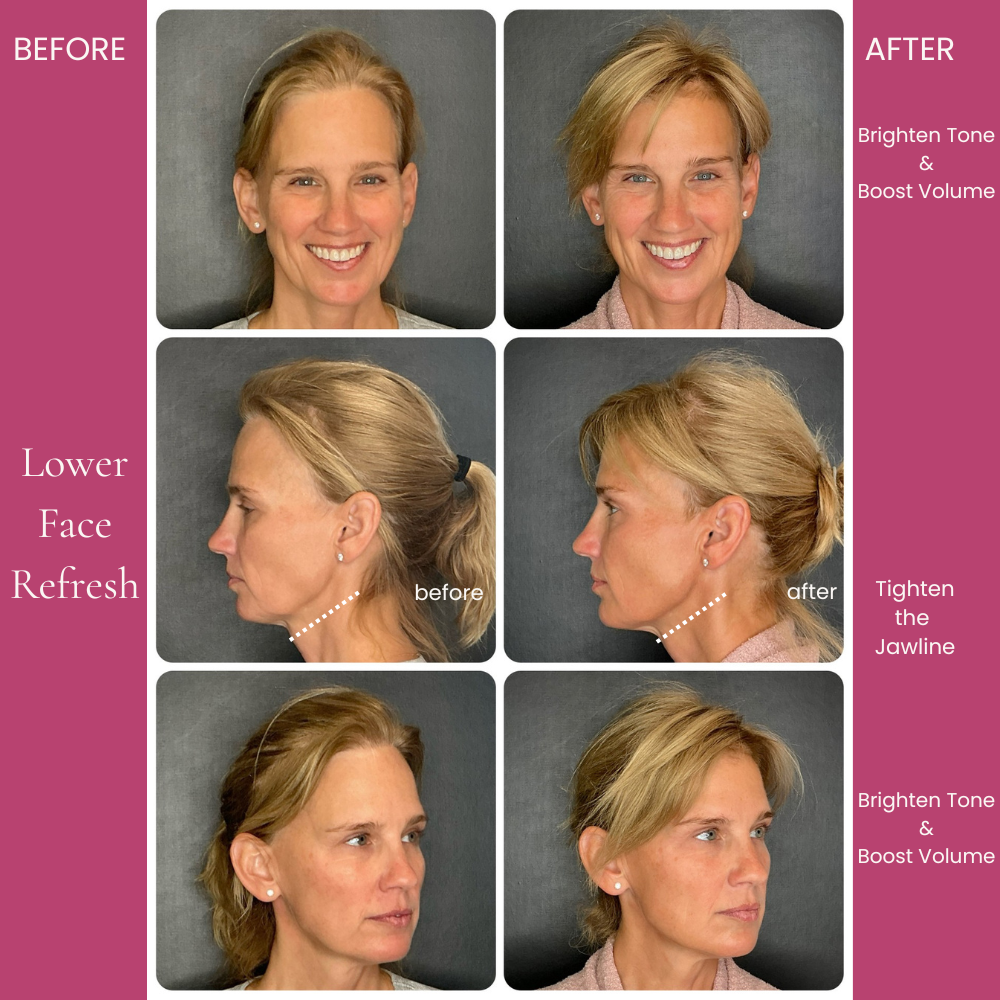 Lower Face Refresh Before and After