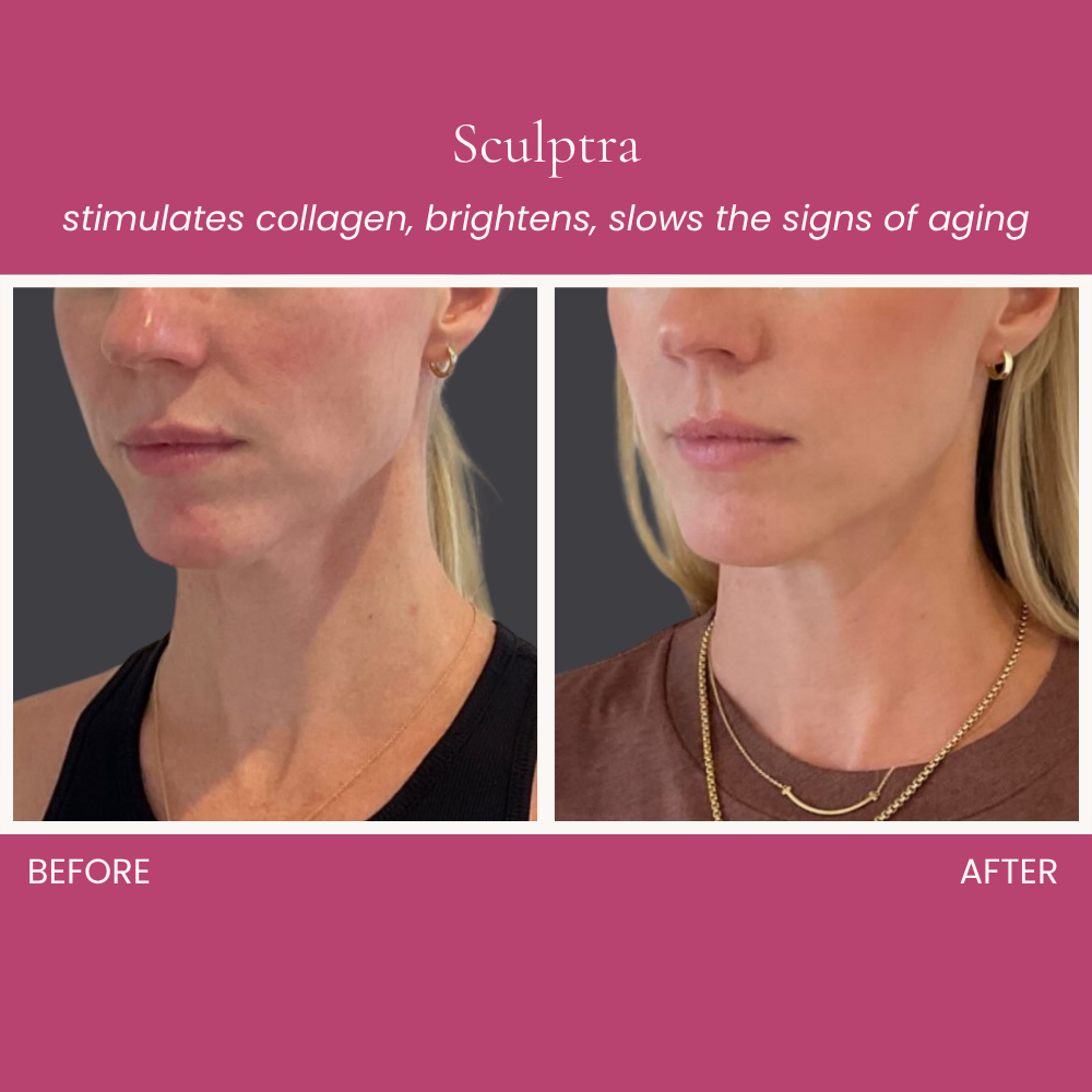Sculptra Before and After