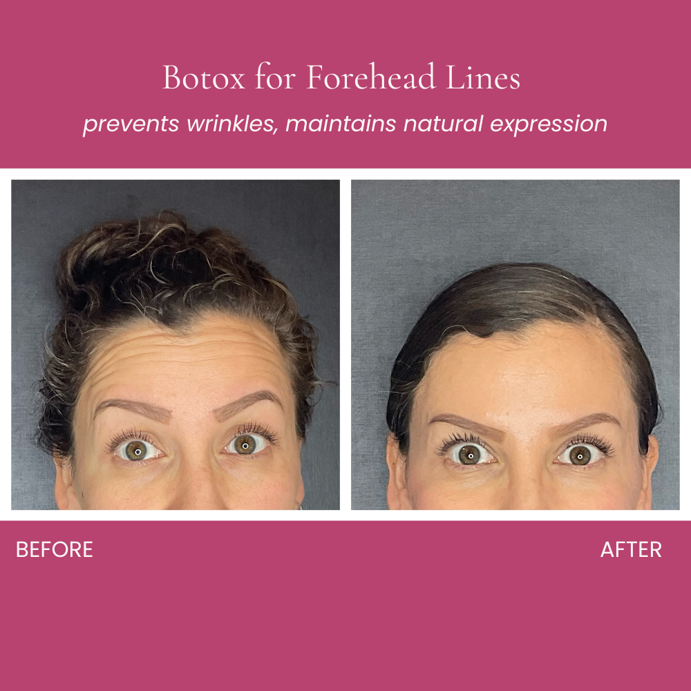 Botox for Forehead Lines Before and After