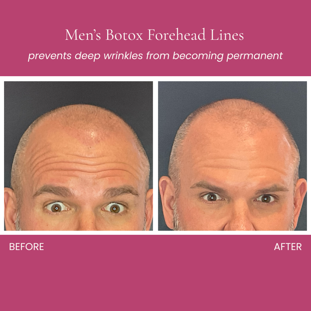 Botox for Men Before and After