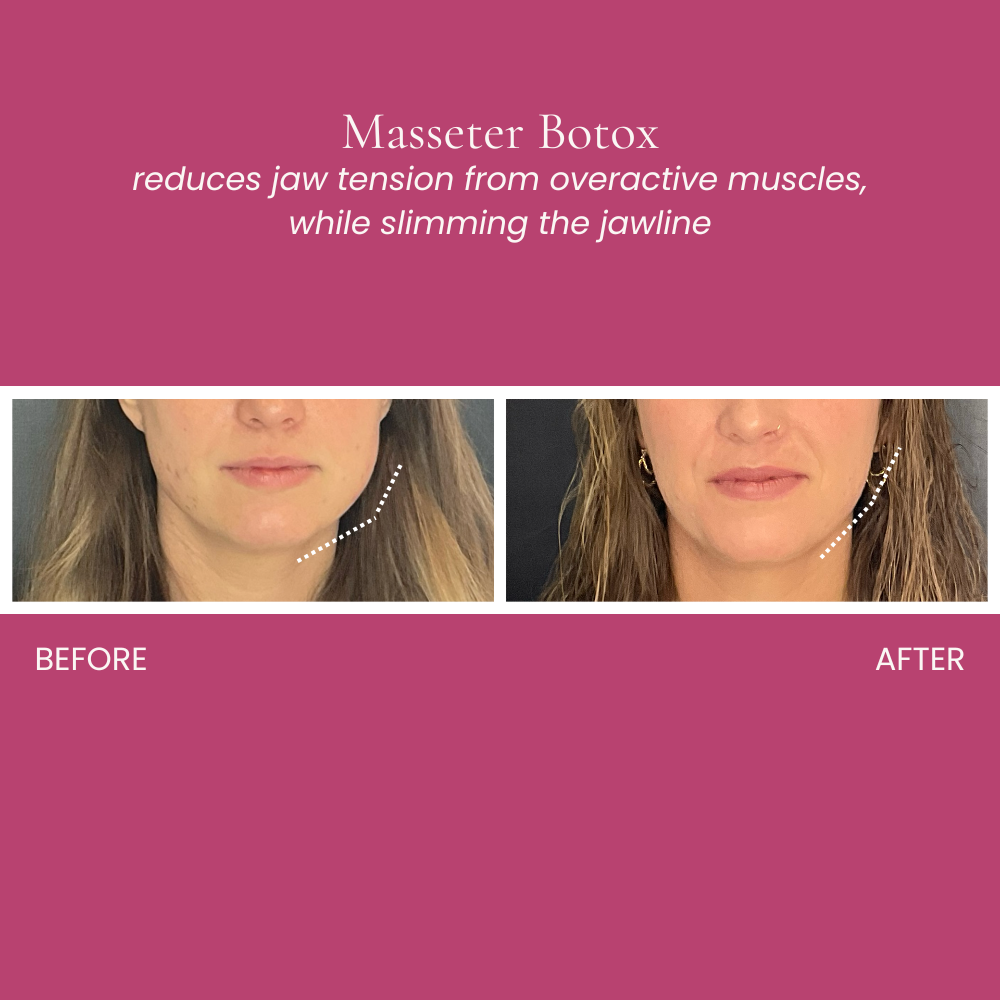 Masseter Botox Before and After