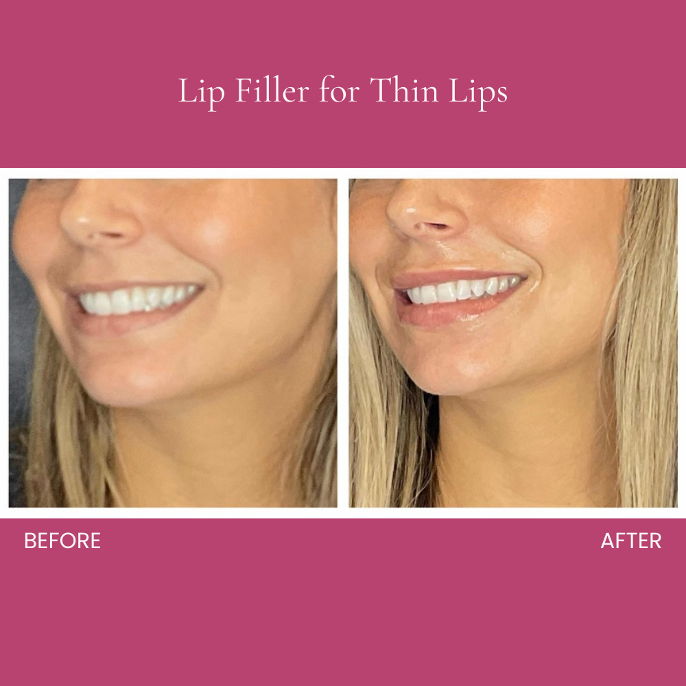 Lip Filler for Thin Lips Before and After