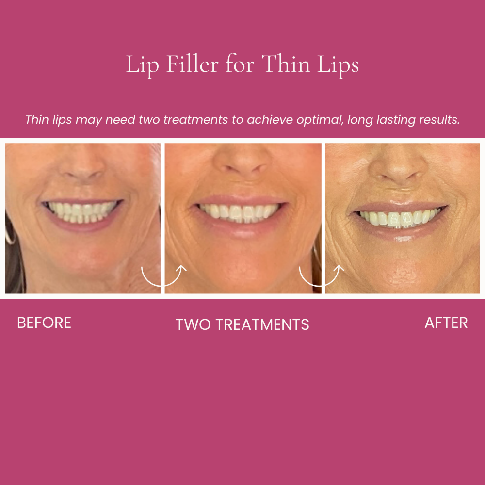 Lip Filler for Thin Lips Before and After