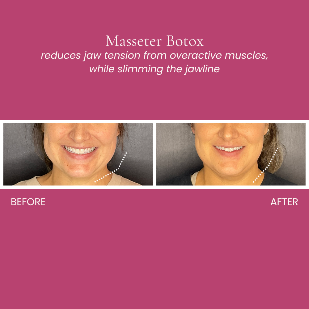 Masseter Botox Before and After