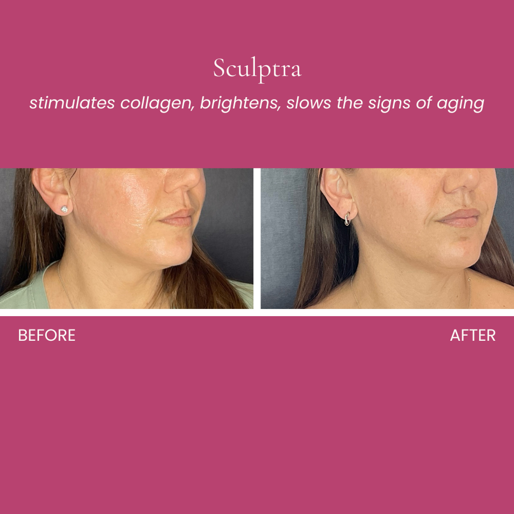 Sculptra Before and After