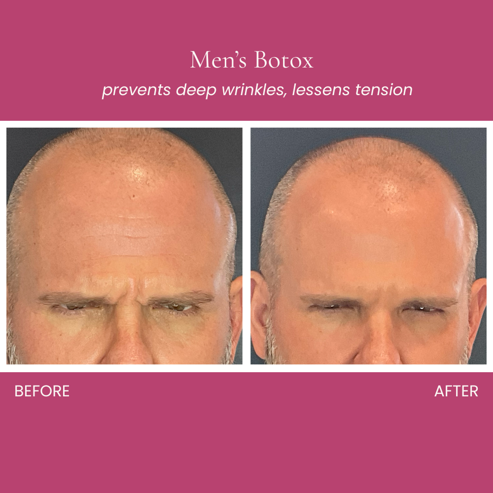 Botox for Men Before and After
