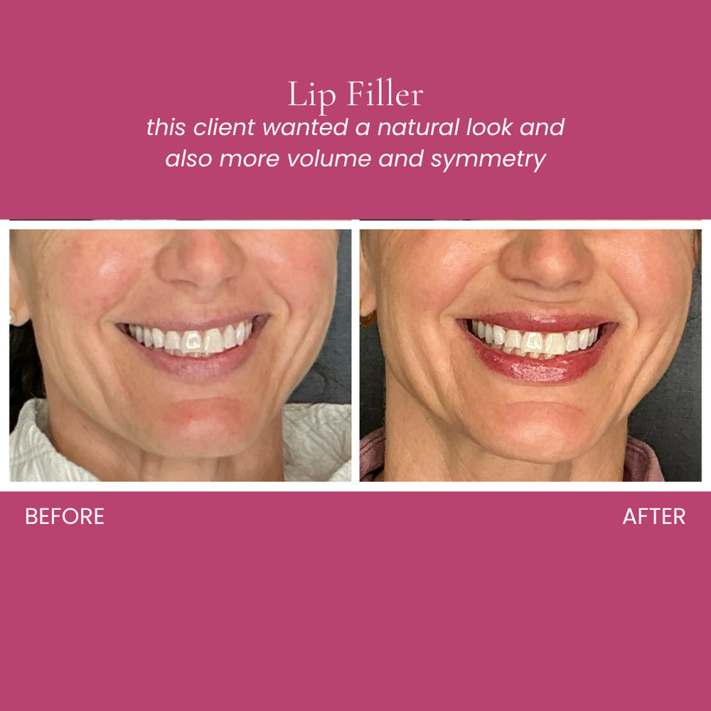 Lip Filler Before and After