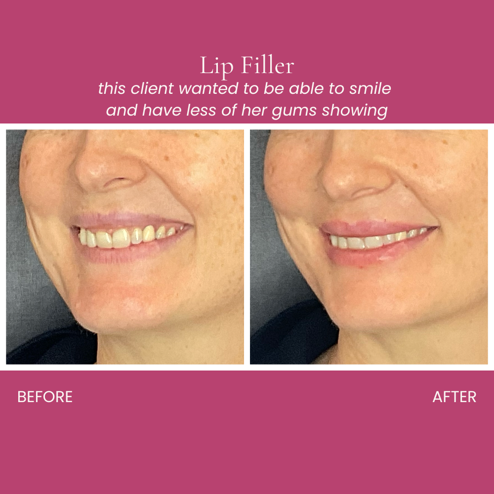 Lip Filler Before and After