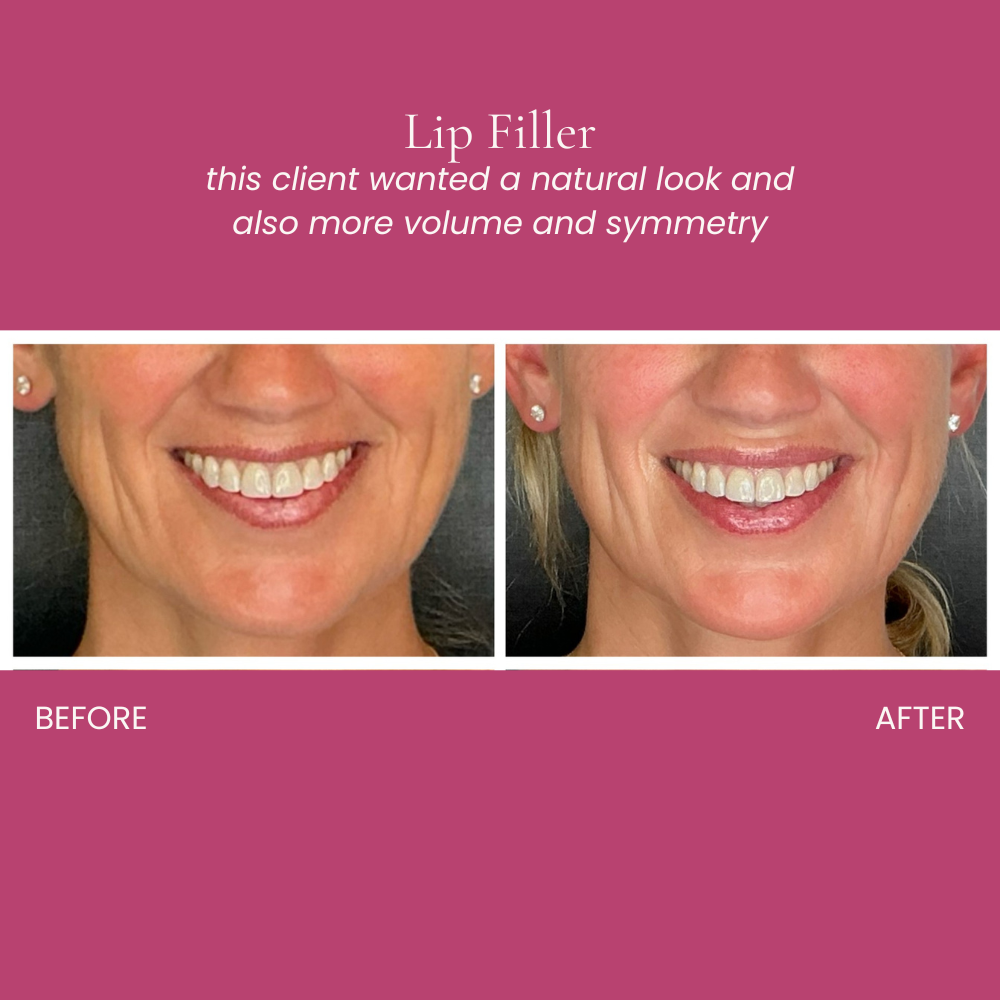 Lip Filler Before and After