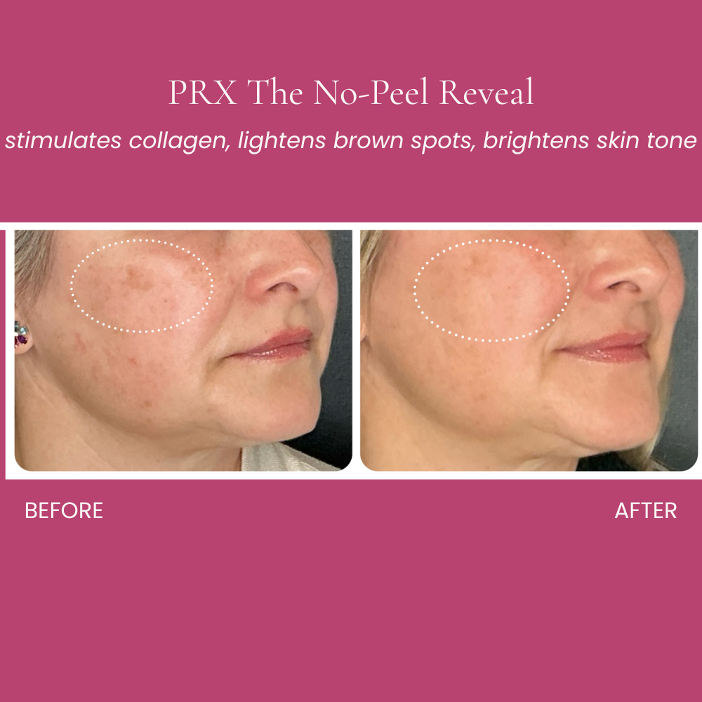 No-Peel Reveal (PRX) Before and After