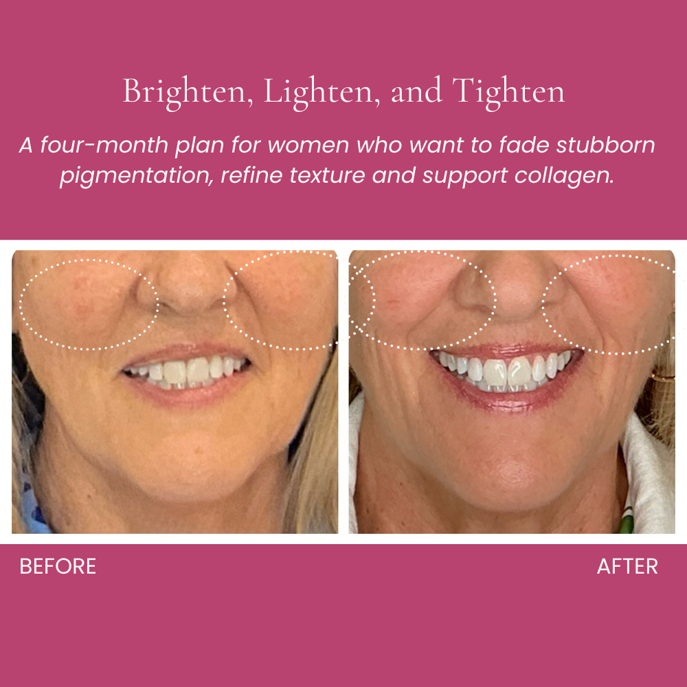 BLT: Lighten brown spots, Brighten skin tone Before and After