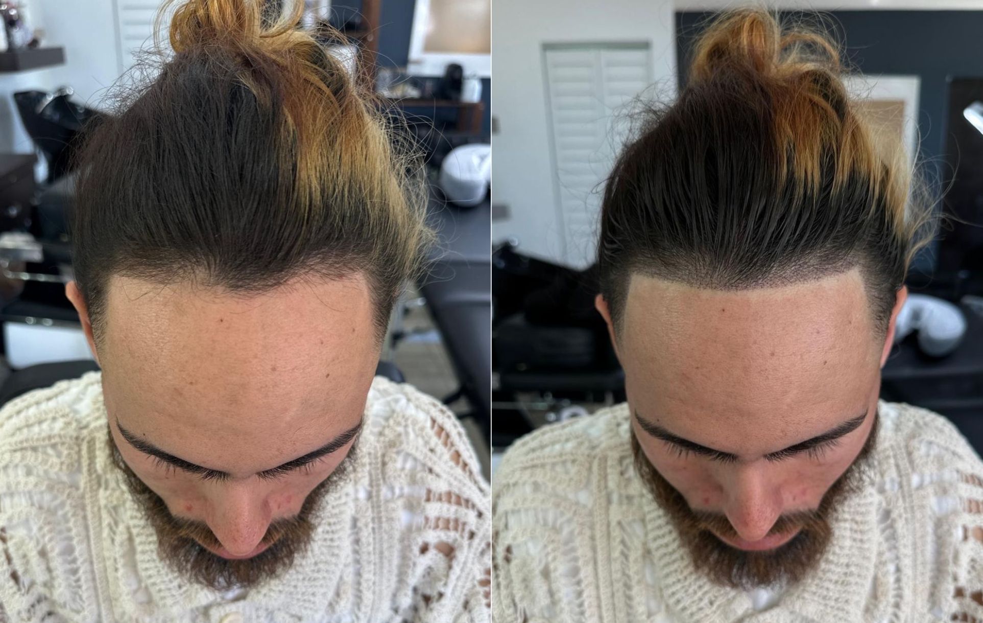 Hairline Restoration SMP