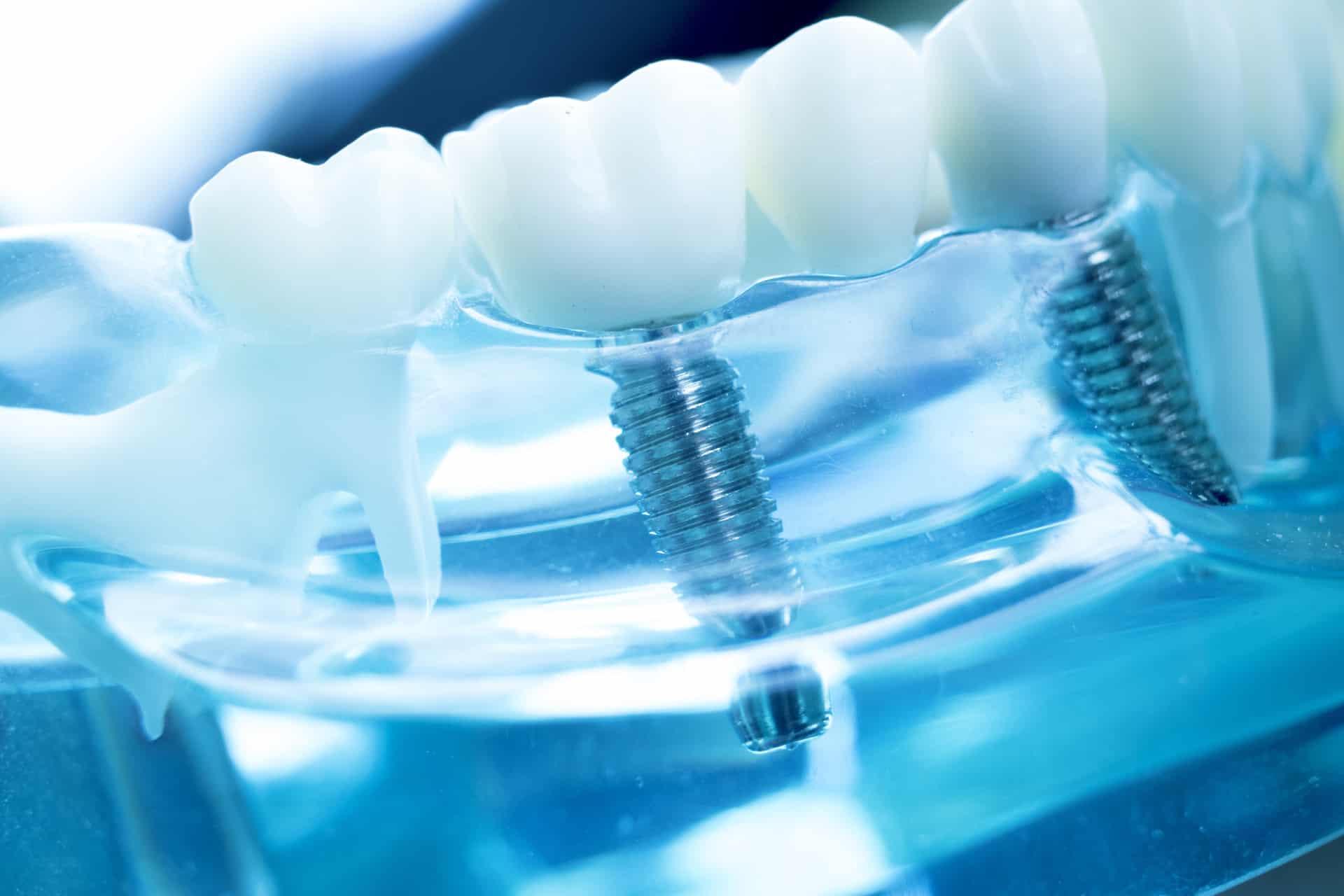 Dental model showing titanium implants supporting replacement teeth
