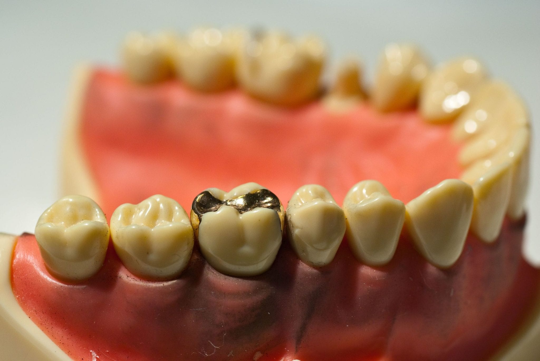 Dental model showing a metal filling beside natural tooth-colored teeth