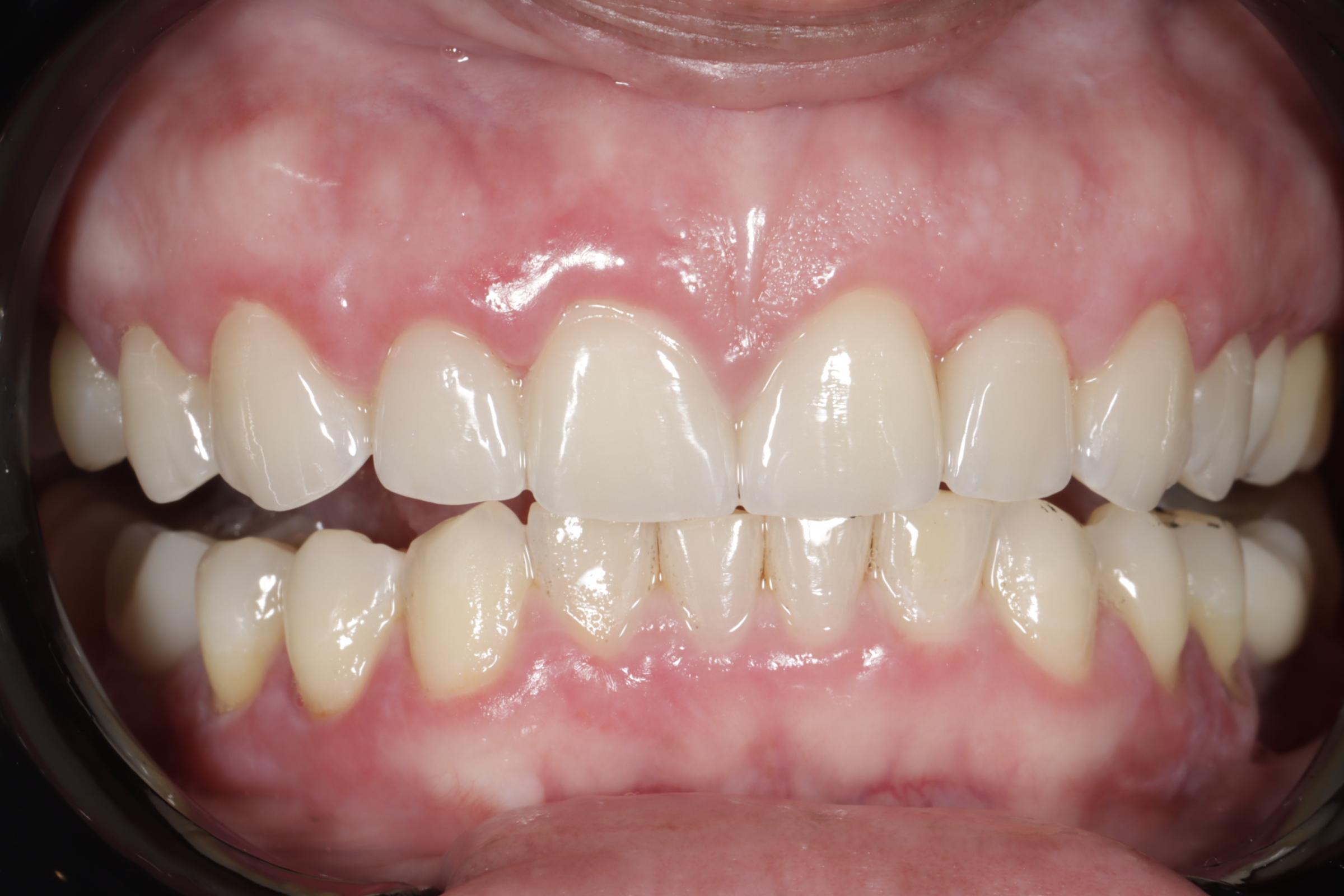 After — finished smile following Invisalign and porcelain veneers at Greenwich Dental Group