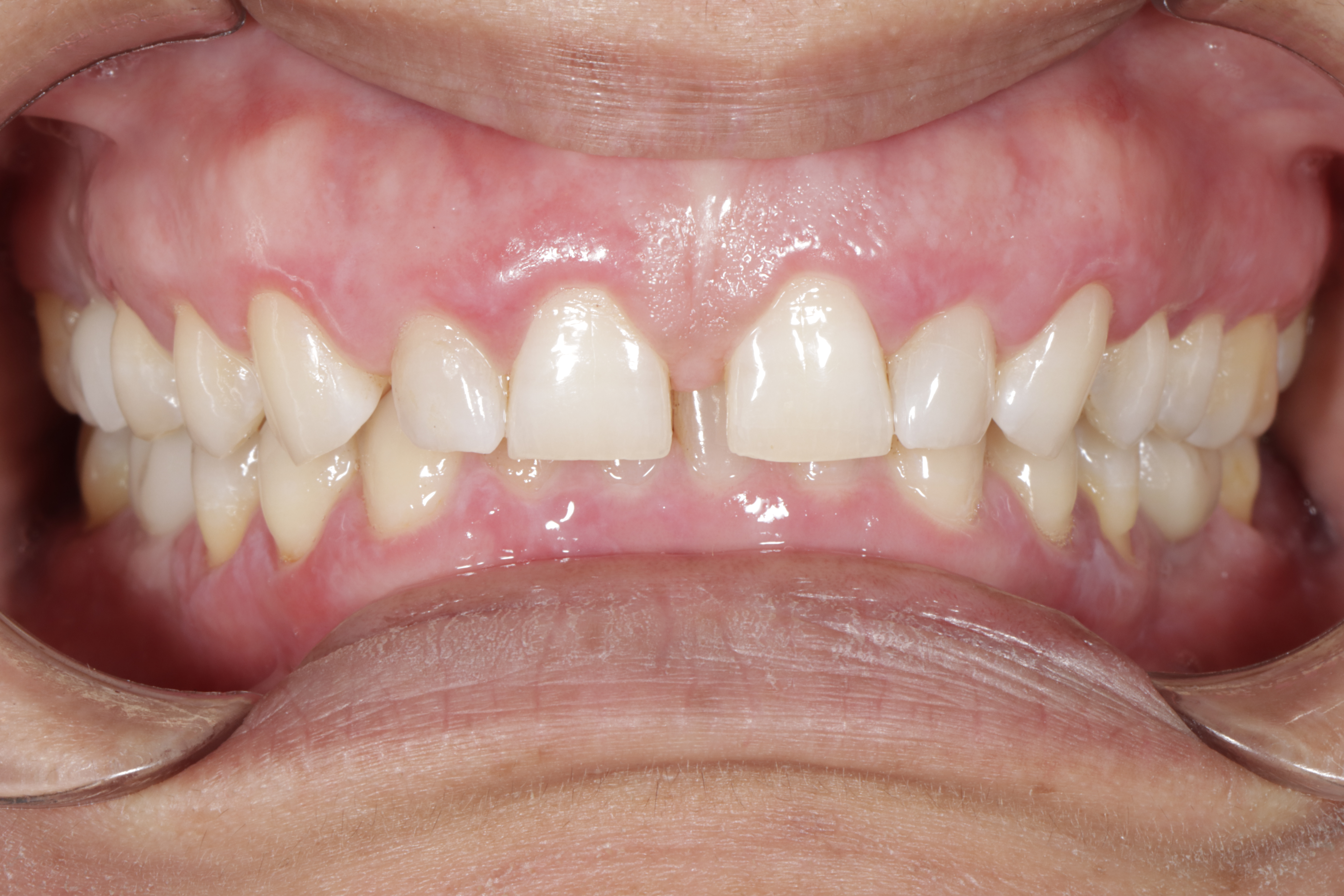 Before — patient smile prior to Invisalign and veneer treatment