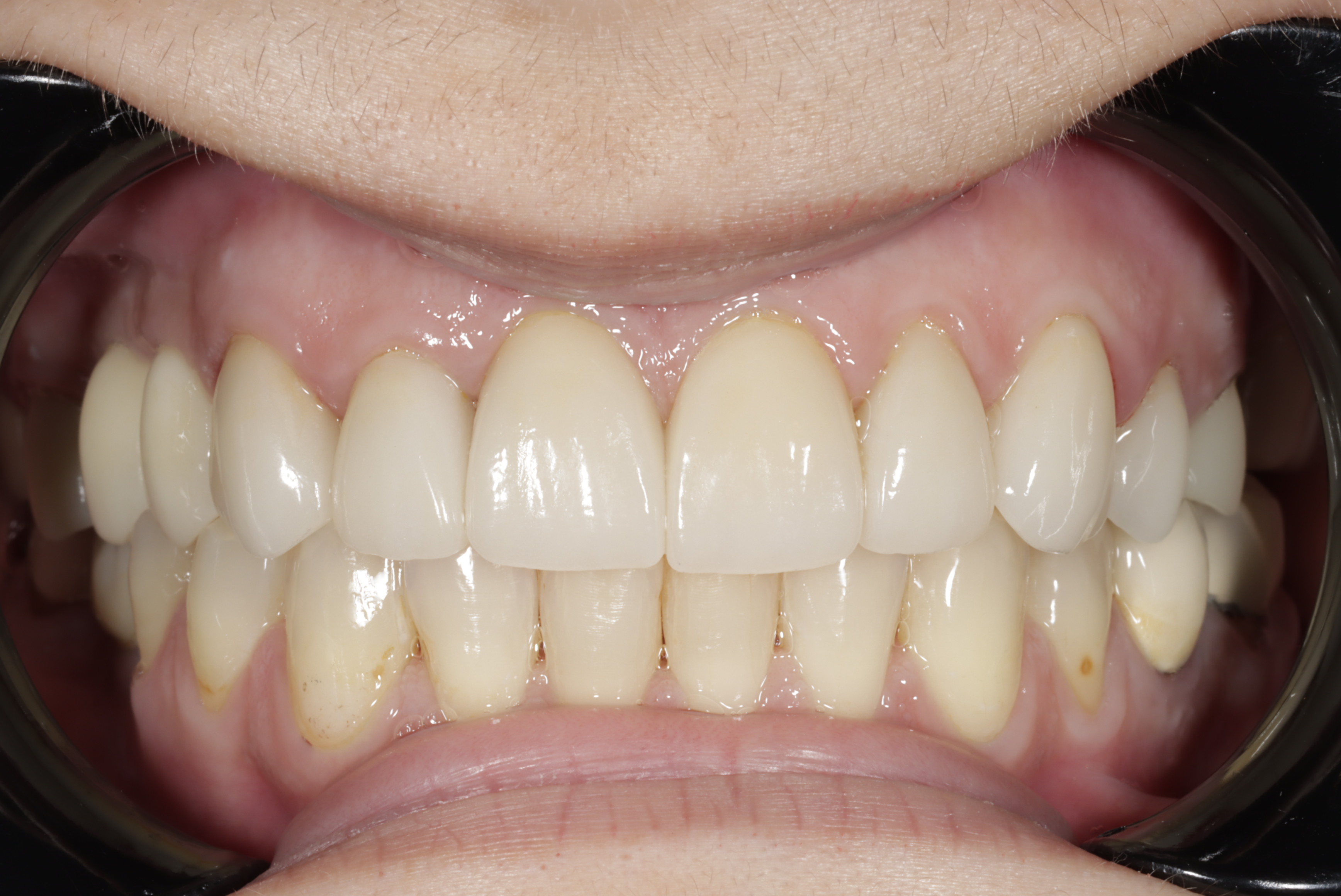 After — completed full mouth makeover at Greenwich Dental Group