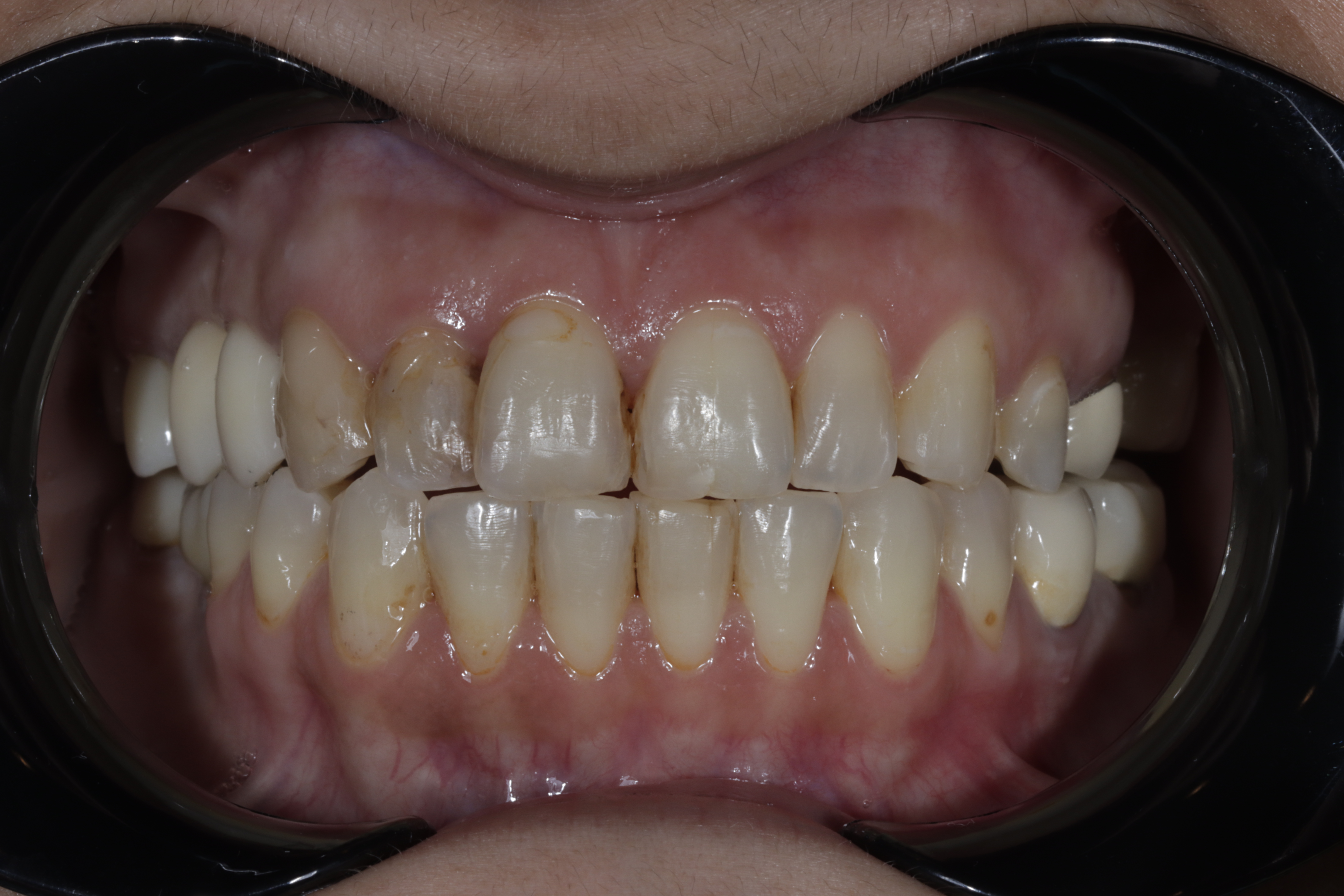 Before — patient smile prior to a full mouth makeover