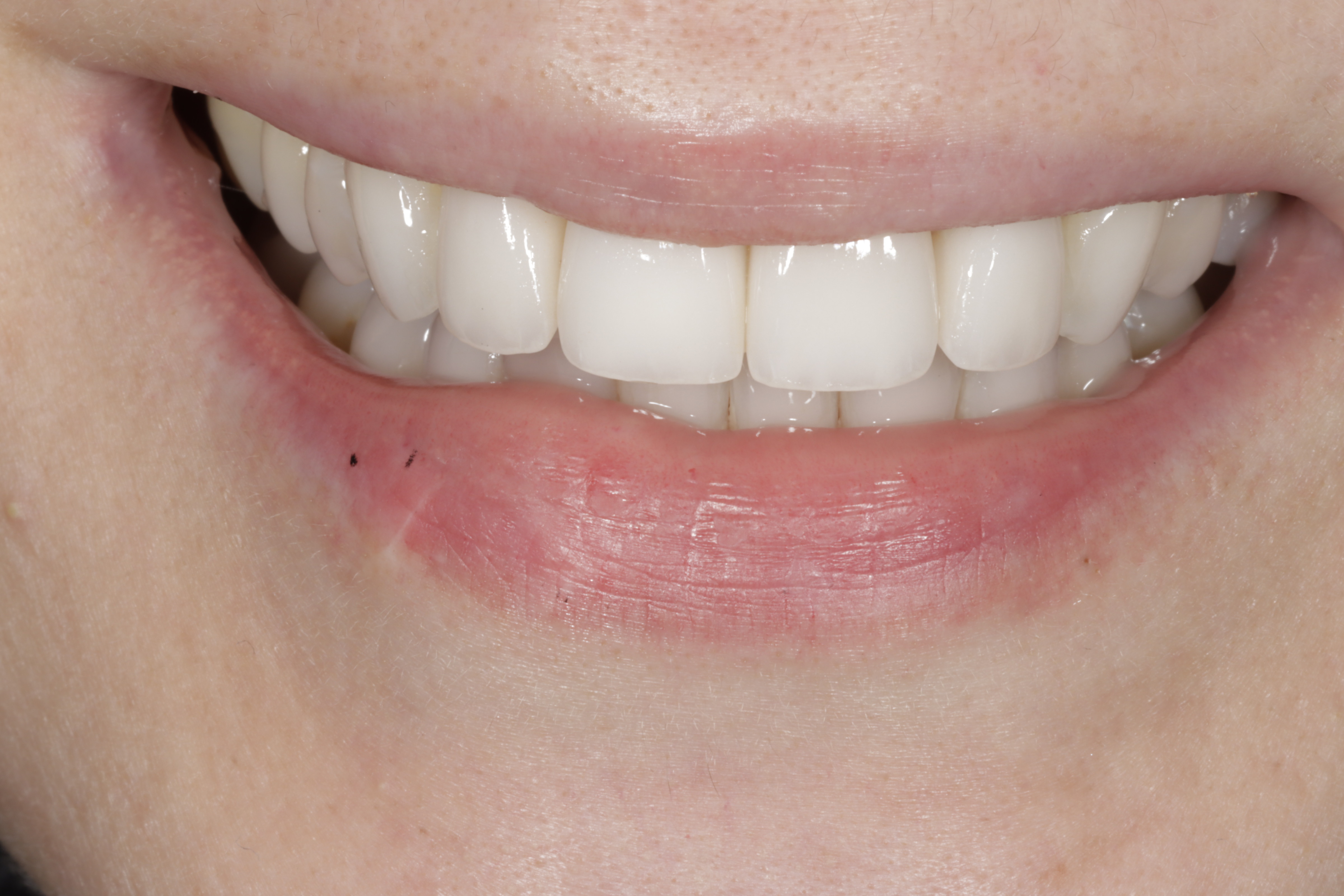 After &mdash; bright, even smile restored with implant-supported porcelain veneers at Greenwich Dental Group