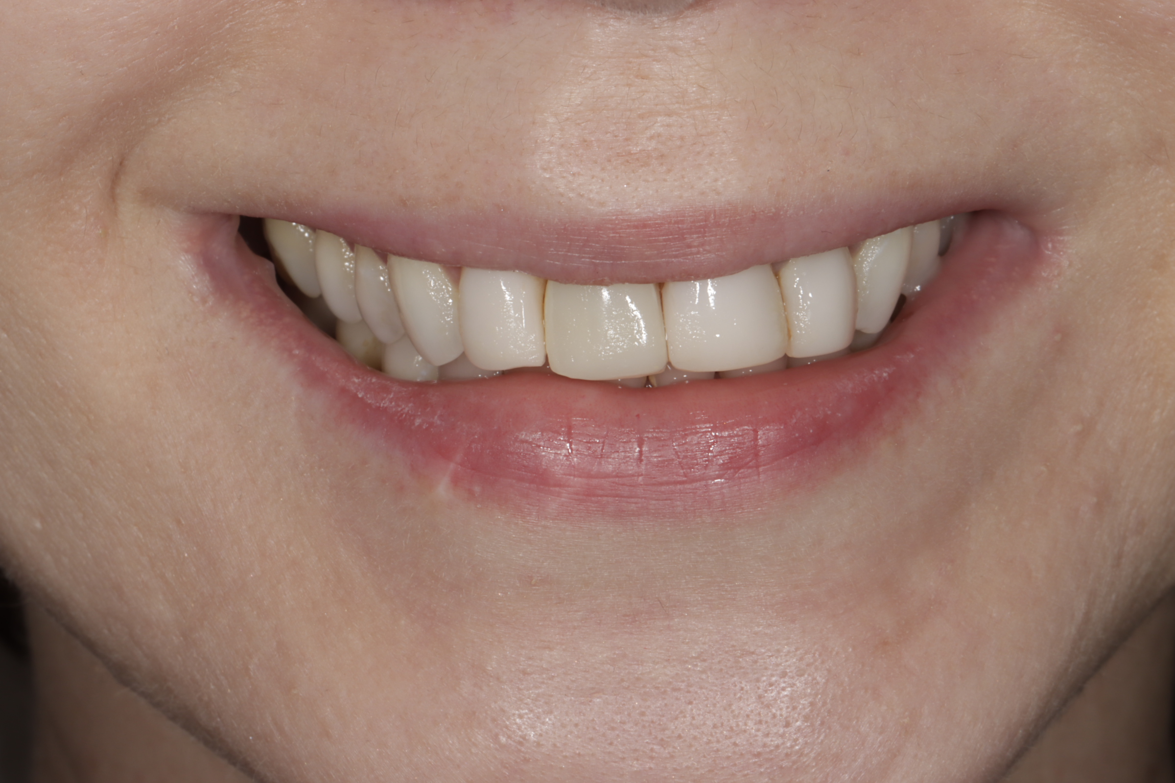Before &mdash; worn, uneven teeth prior to implant-supported porcelain veneers