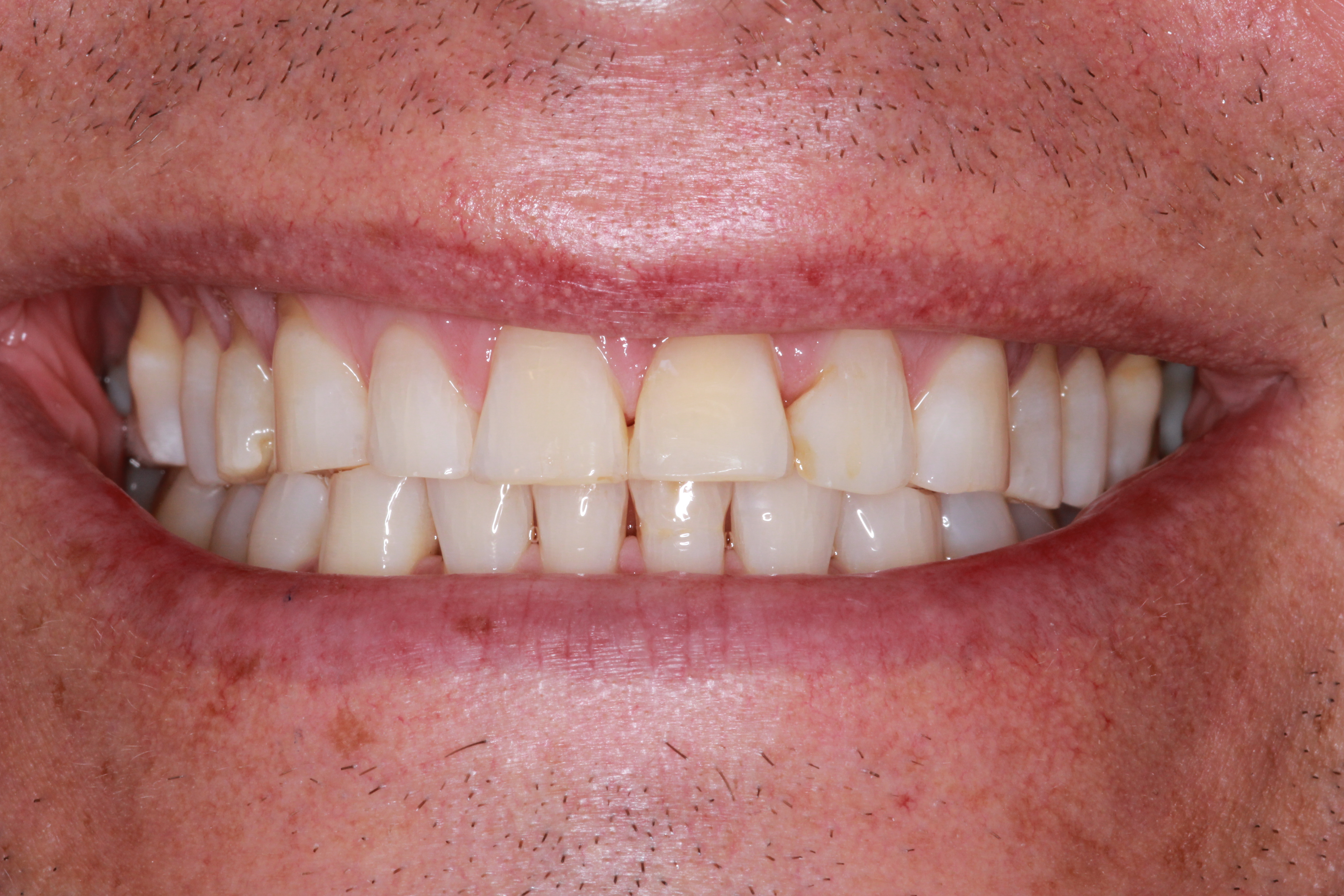 Before &mdash; worn, uneven teeth prior to porcelain veneers