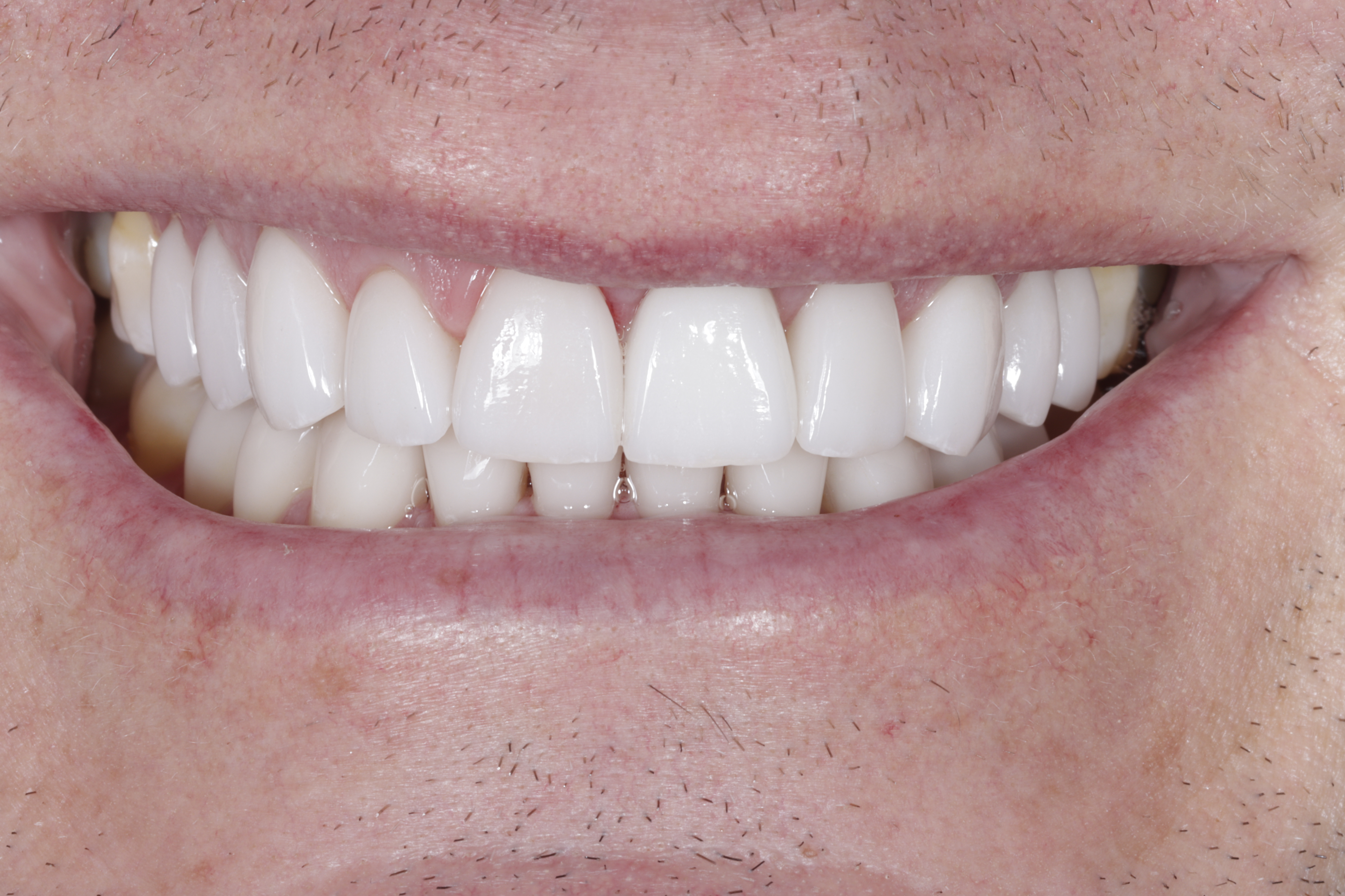 After &mdash; bright, even smile with porcelain veneers at Greenwich Dental Group