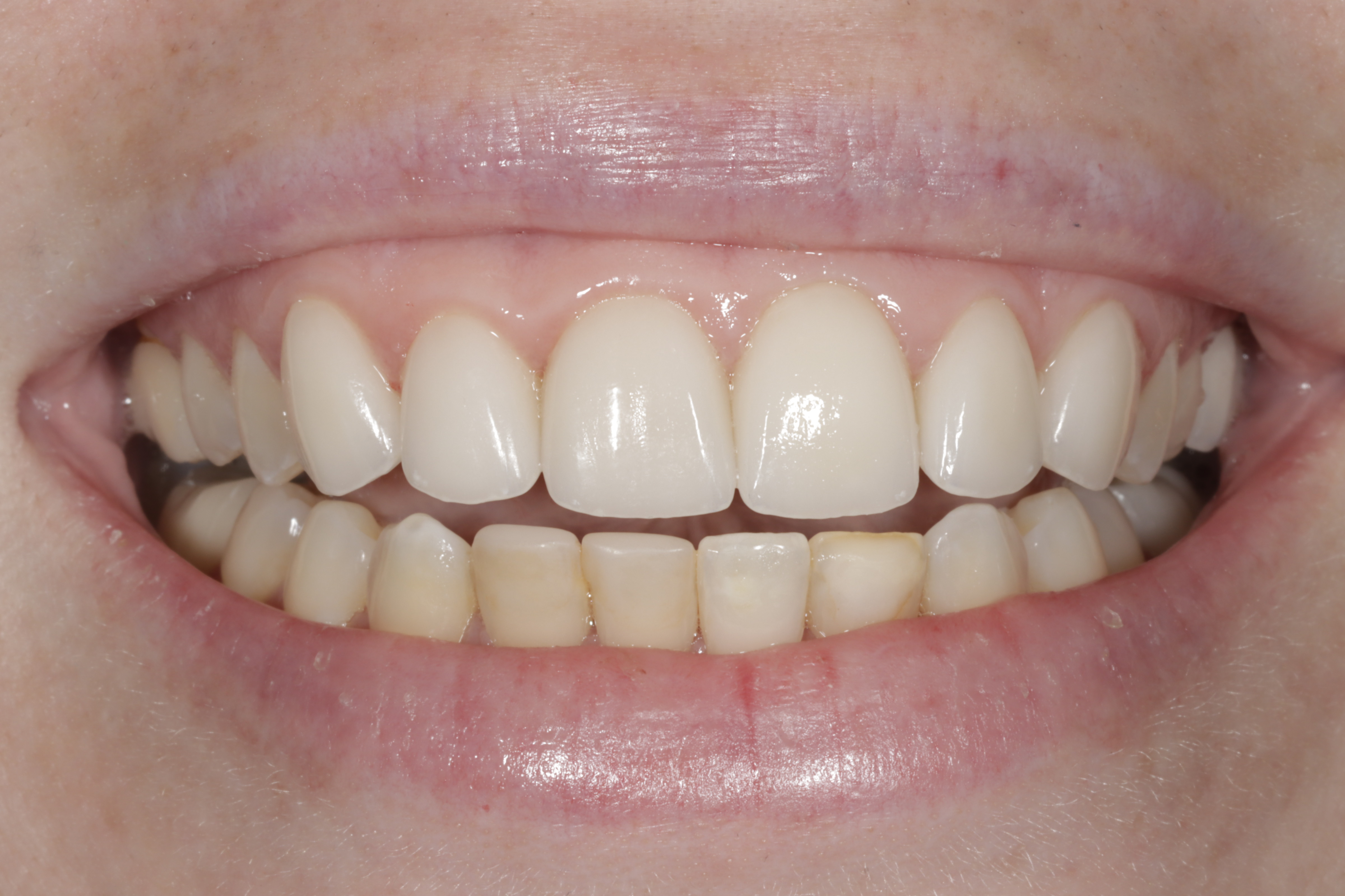After &mdash; even, natural porcelain veneers at Greenwich Dental Group