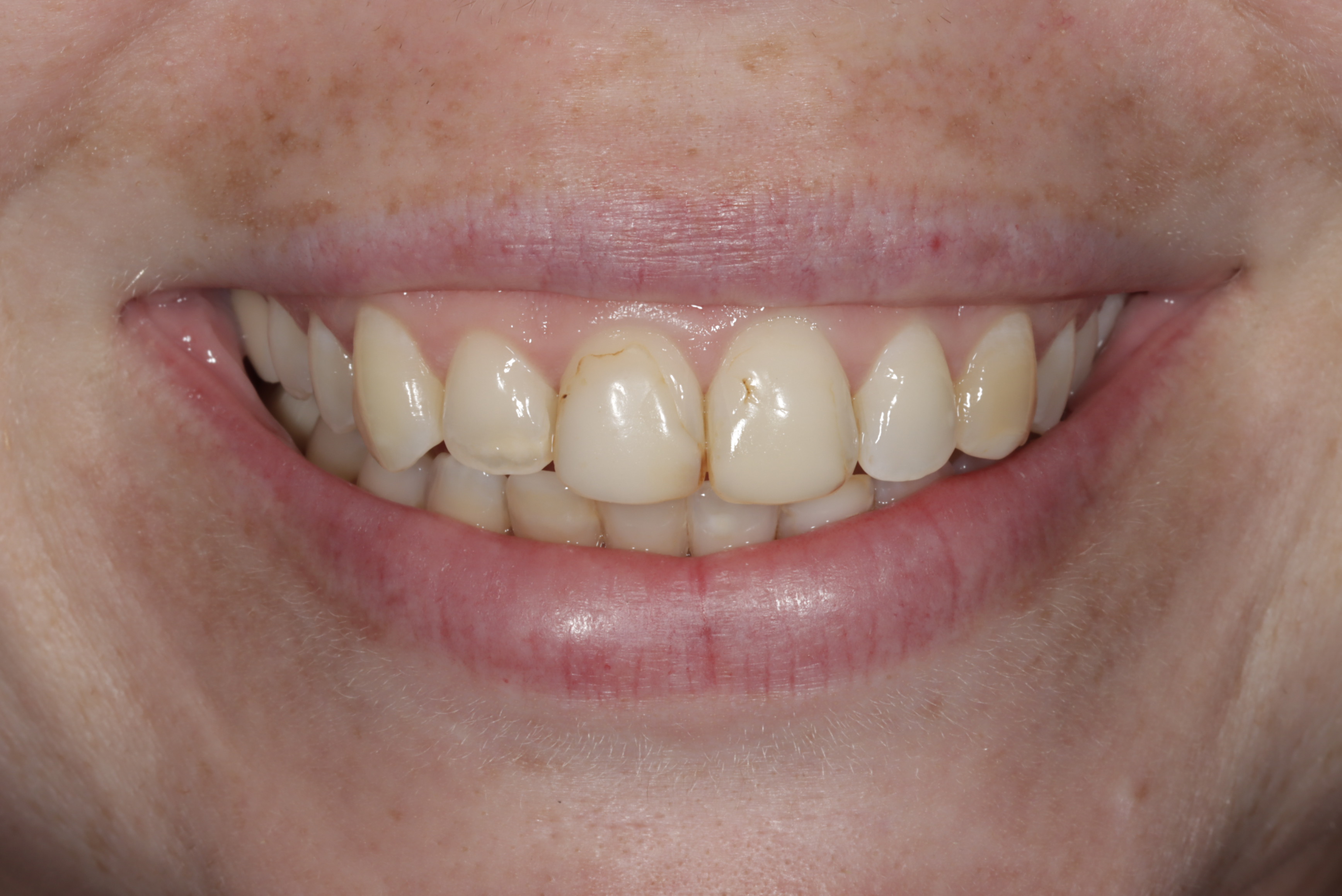 Before &mdash; discolored, worn front teeth prior to porcelain veneers