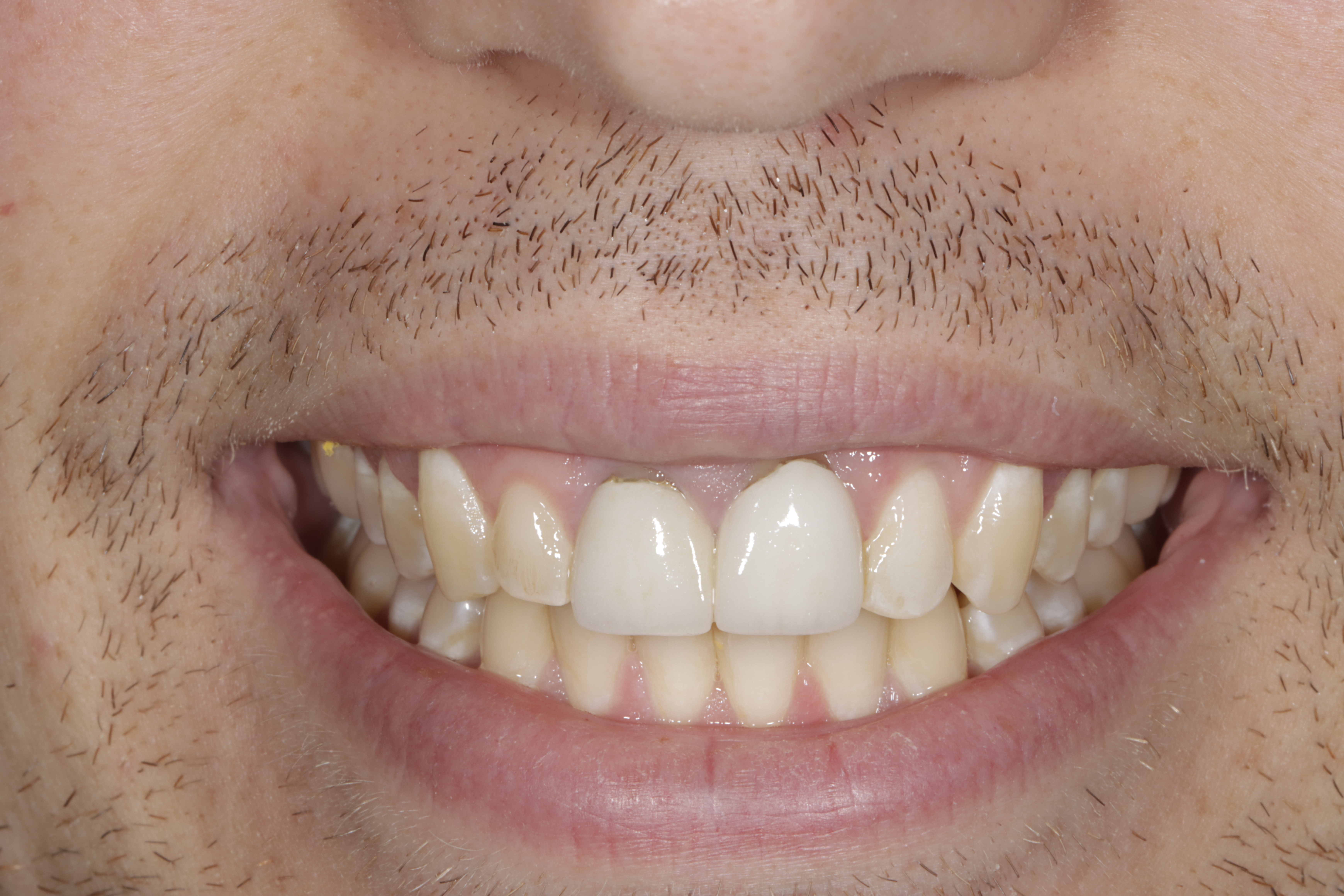 Before &mdash; mismatched, discolored front teeth prior to porcelain veneers