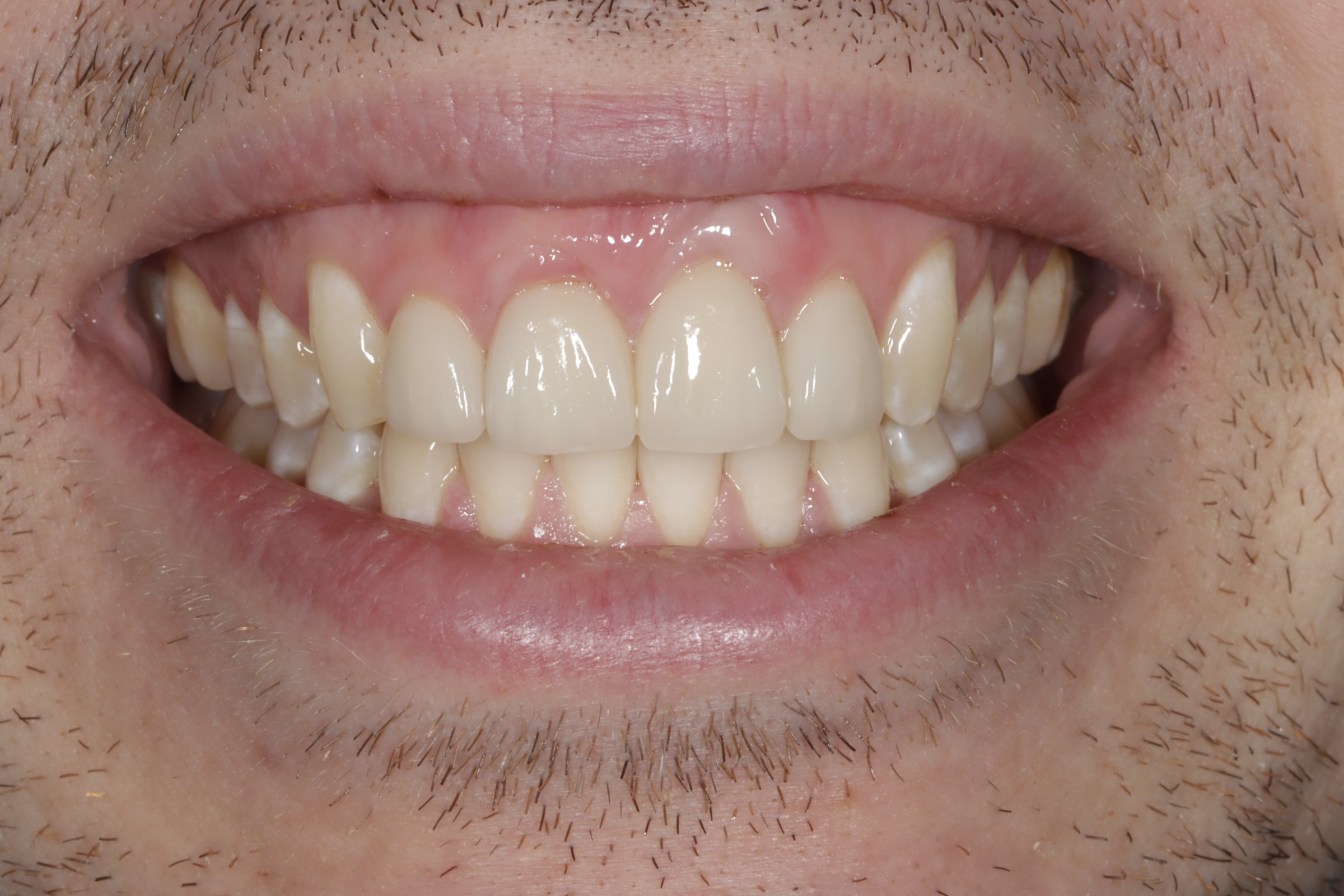 After &mdash; balanced, natural porcelain veneers at Greenwich Dental Group