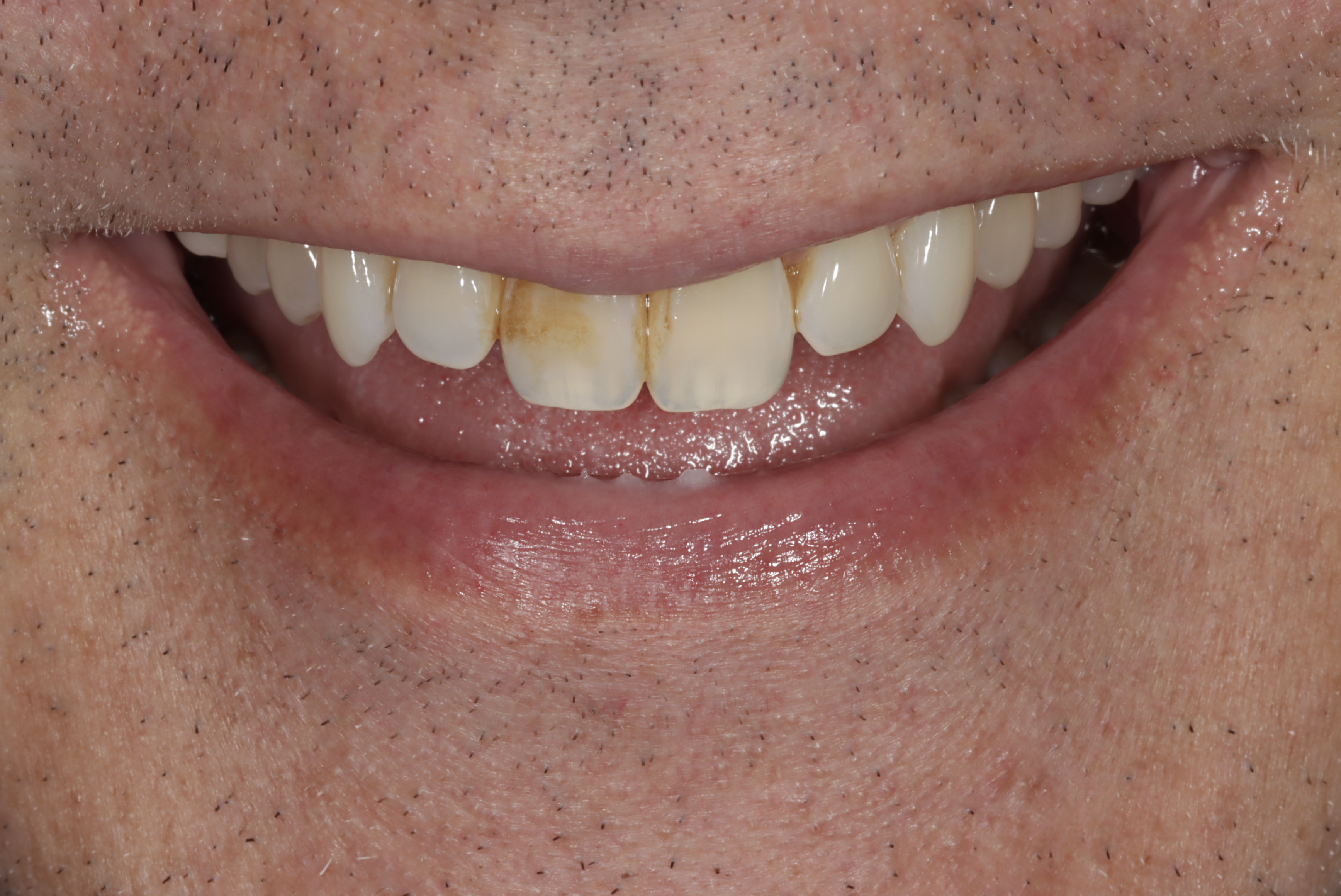 Before &mdash; stained, worn teeth prior to porcelain veneers