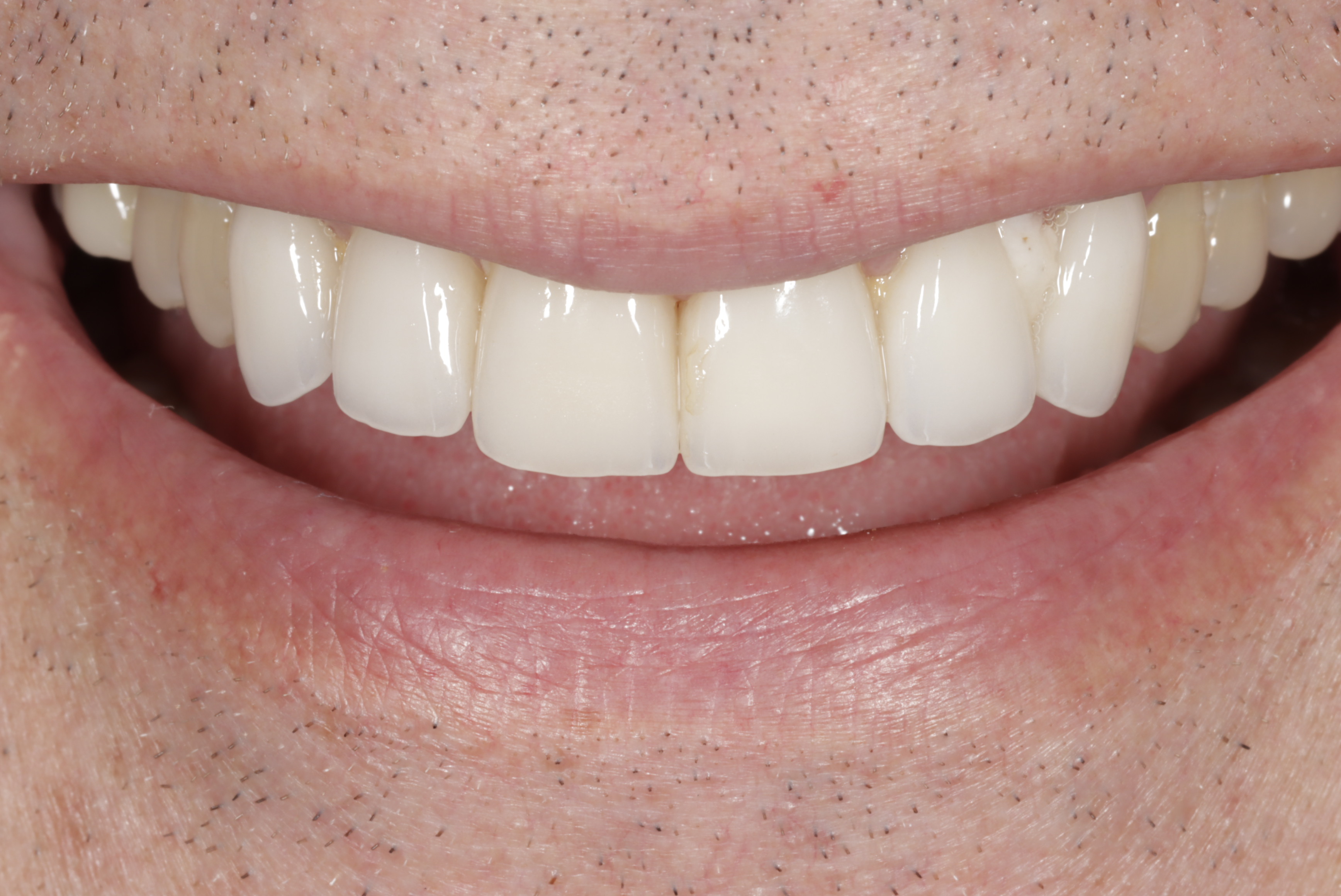 After &mdash; clean, even porcelain veneers at Greenwich Dental Group