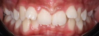 Child with crowded teeth