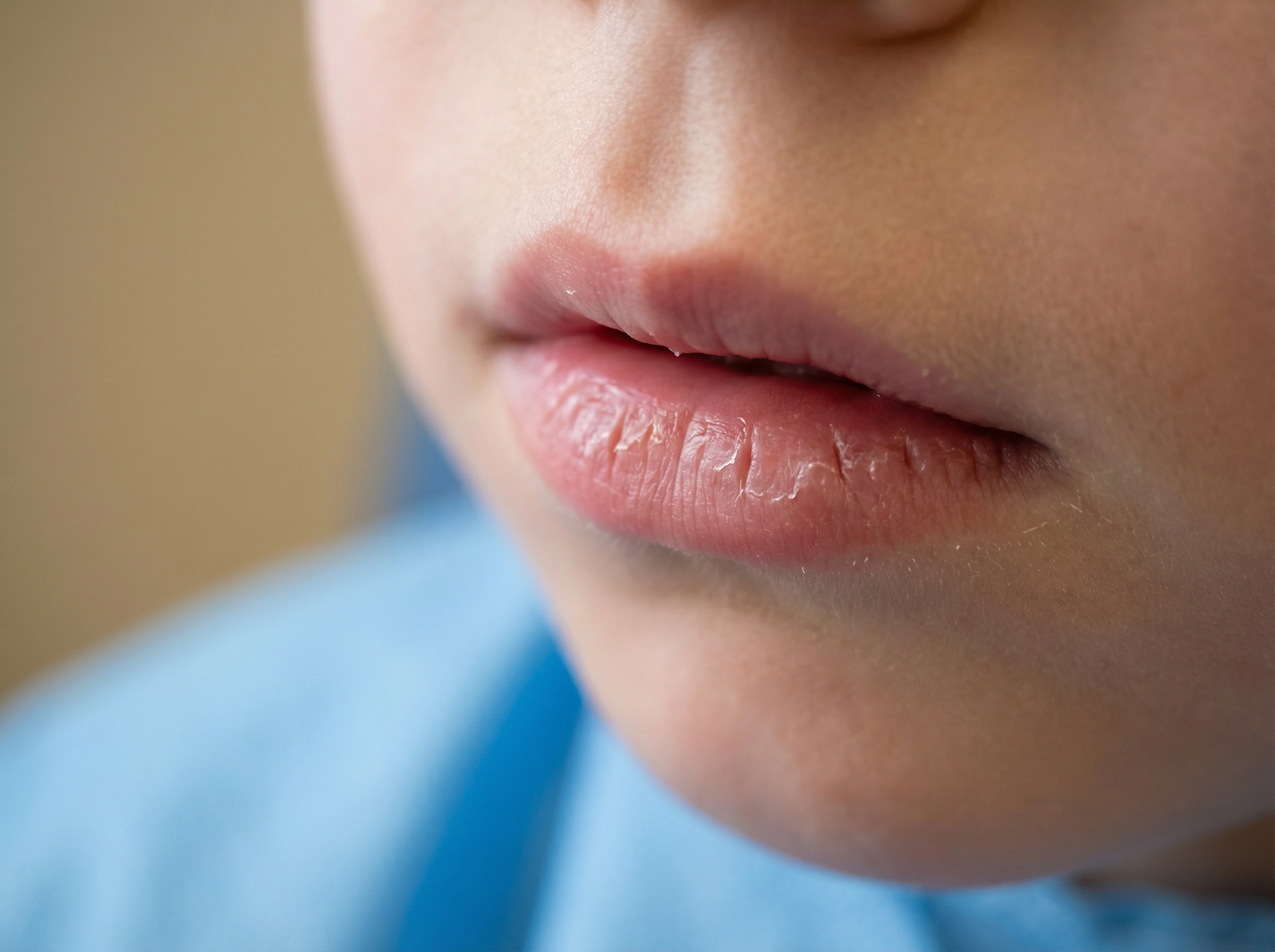 Child with chapped dry lips