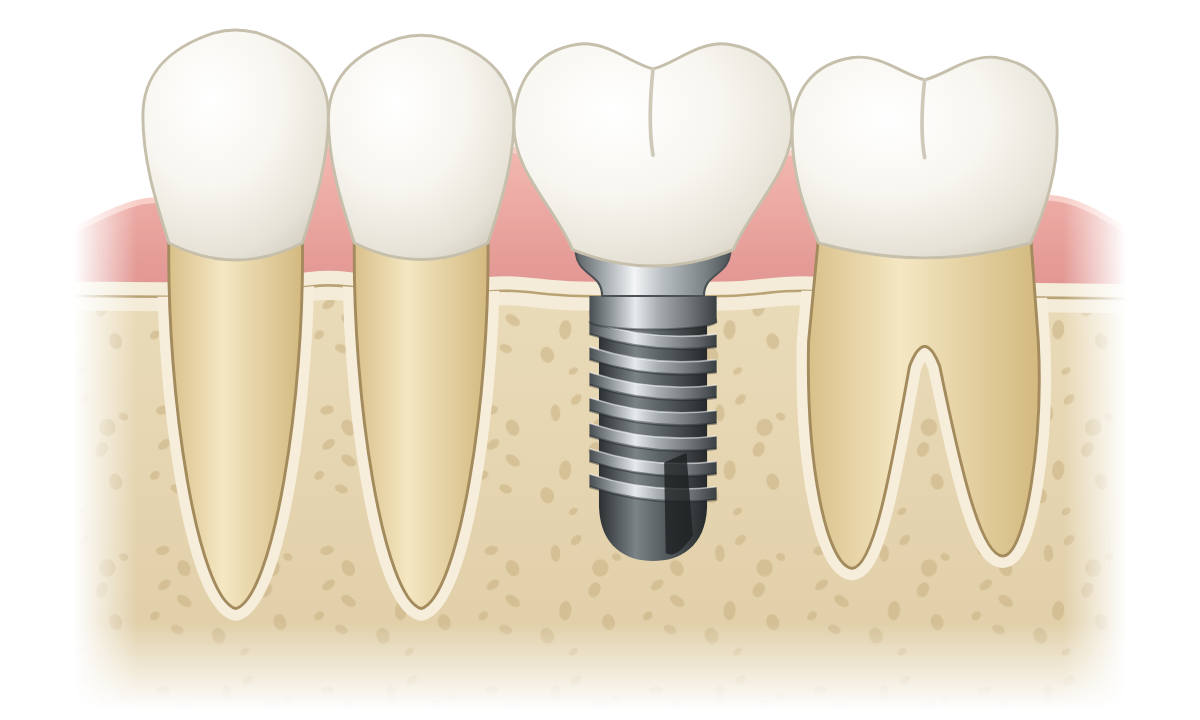 Single dental implant with one crown