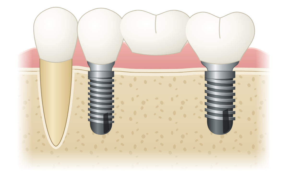 Implant bridge: two implants supporting a row of joined crowns