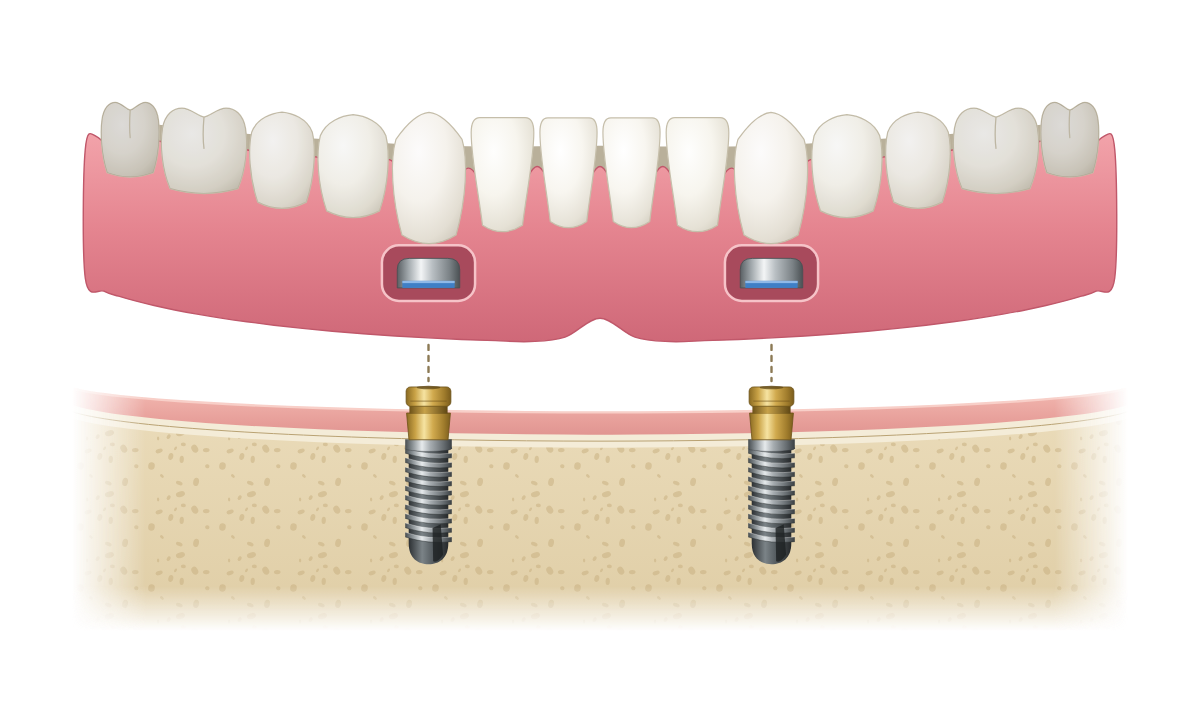 Implant-retained denture held by locator attachments on two implants