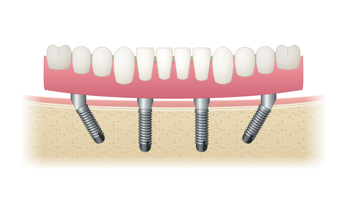 Fixed full-arch bridge supported by four implants