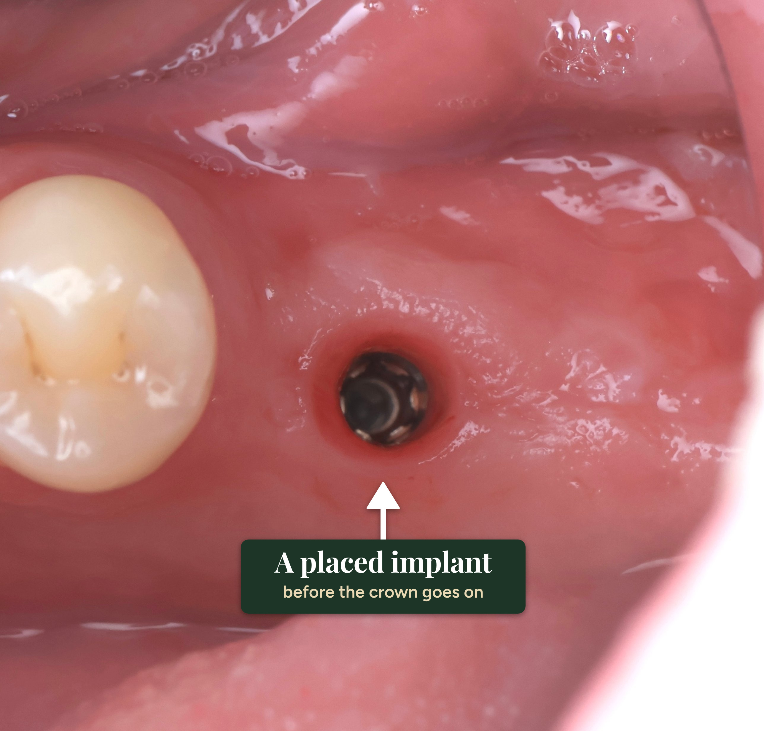 A real dental implant placed in the jaw, before the crown is fitted, with the implant labelled