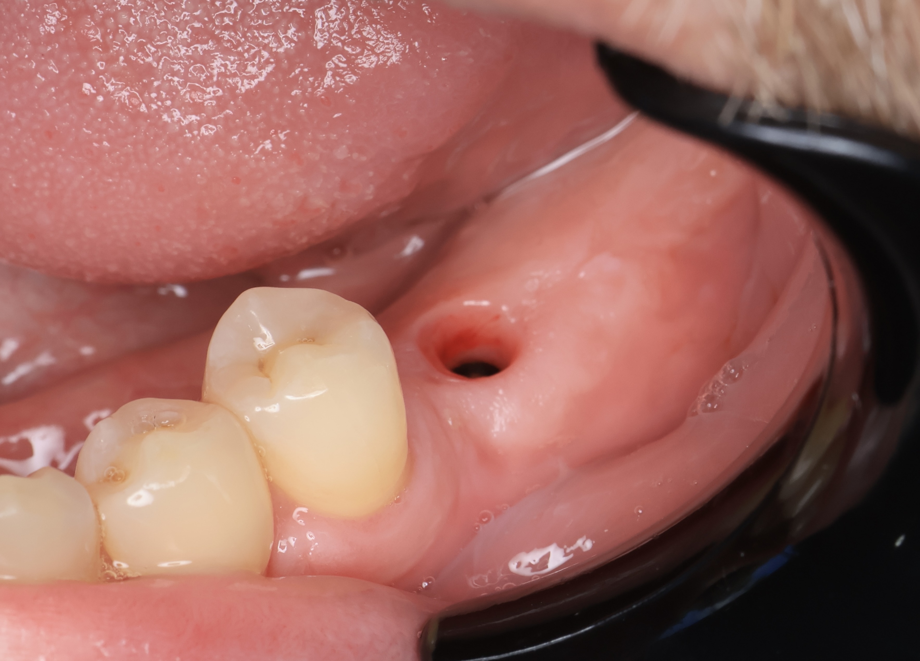 Real patient: healed dental implant in the gum before the crown is fitted