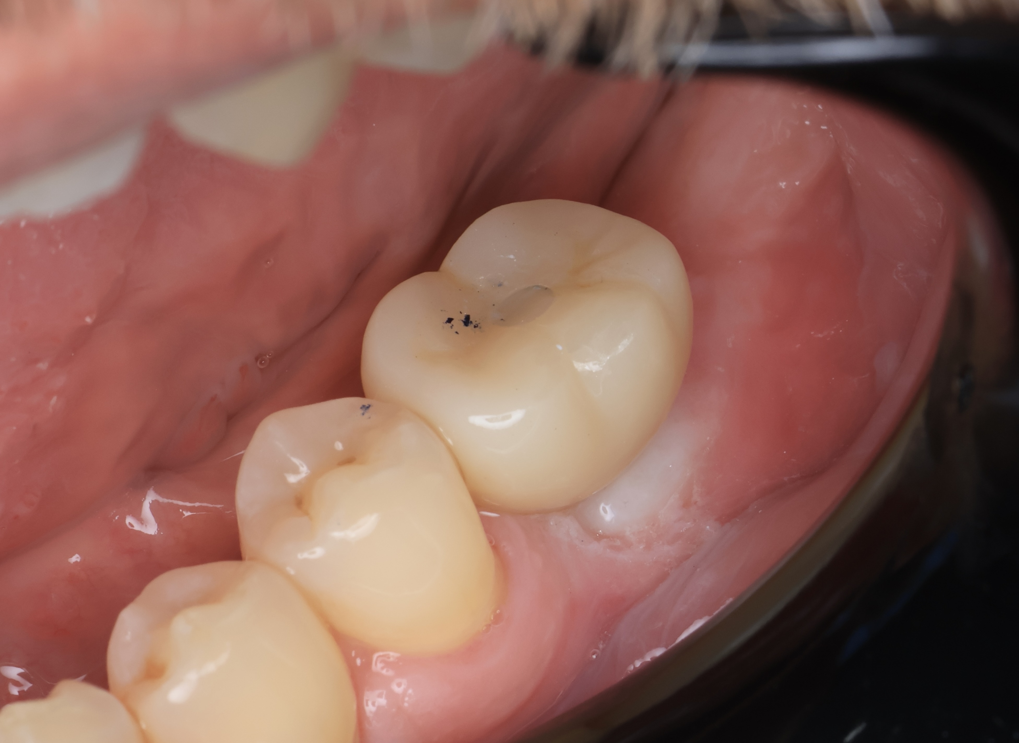 Real patient: the same dental implant with the final crown fitted