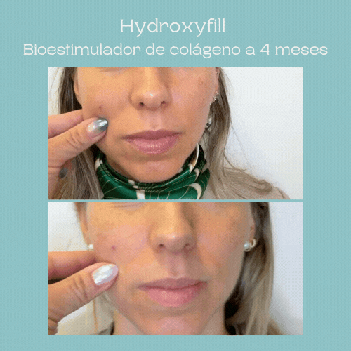 Hydrofill