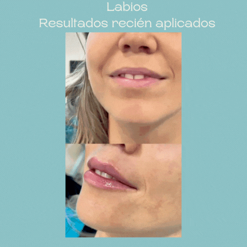 Labios