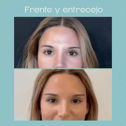 Frente y Entrecejas