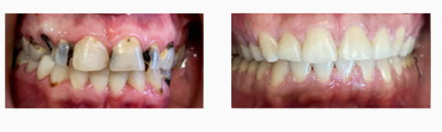 veneers and smile makeover results north brunswick nj