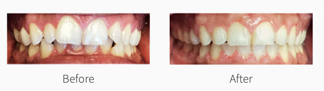 cosmetic dentistry before and after north brunswick nj