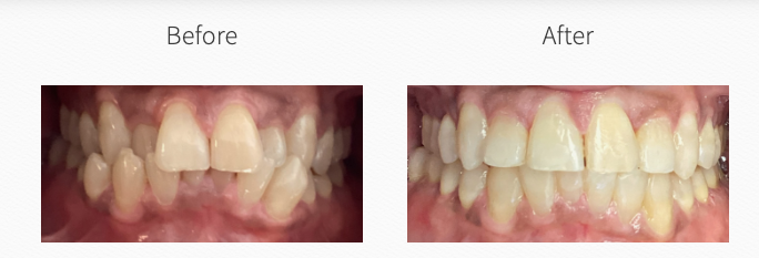 smile makeover before and after north brunswick nj