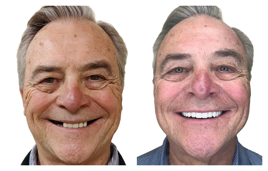 Before and After 1